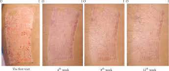 Madecassoside can prevent and treat hypertrophic scars